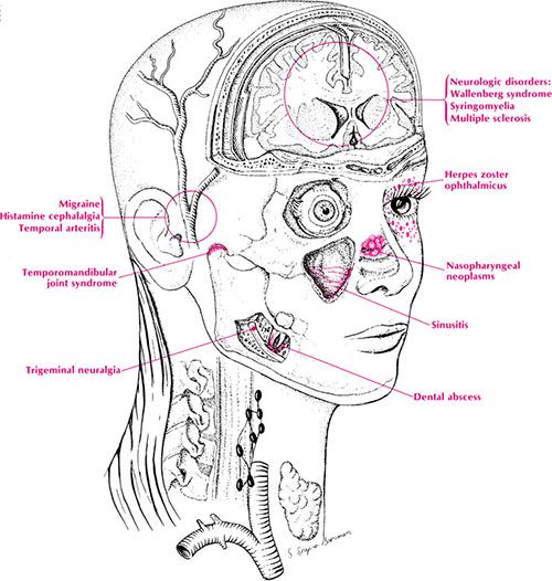 Atypical Facial Pain